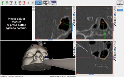 ENT Navigation Software 5.6.0 with Intraoperative Manual Registration Refinement